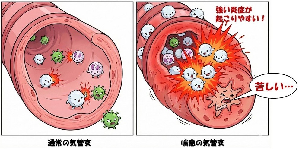 喘息とインフルエンザ