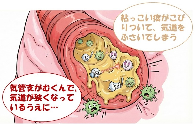 喘息とインフルエンザ